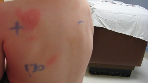 This was her first skin test, June 2008.  The funny characters at the bottom are the peanut exposure.  The top ones are controls.